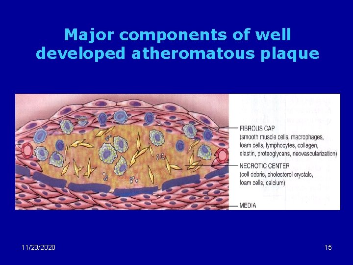 Major components of well developed atheromatous plaque 11/23/2020 15 