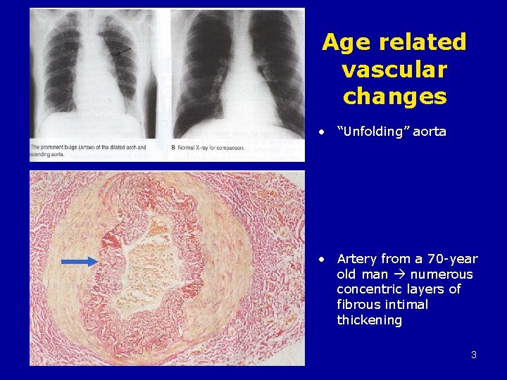Age related vascular changes • “Unfolding” aorta • Artery from a 70 -year old