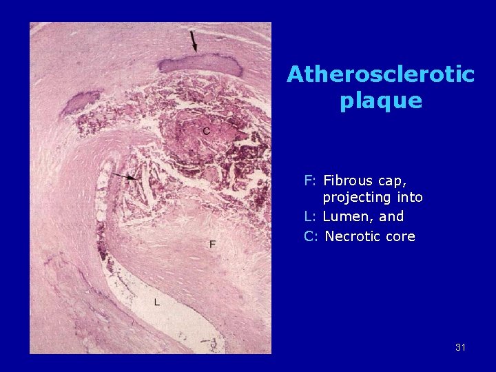 Atherosclerotic plaque F: Fibrous cap, projecting into L: Lumen, and C: Necrotic core 11/23/2020