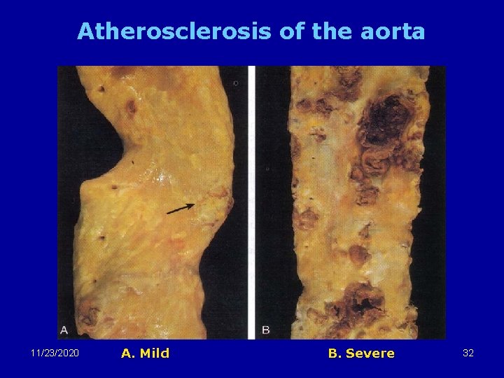 Atherosclerosis of the aorta 11/23/2020 A. Mild B. Severe 32 