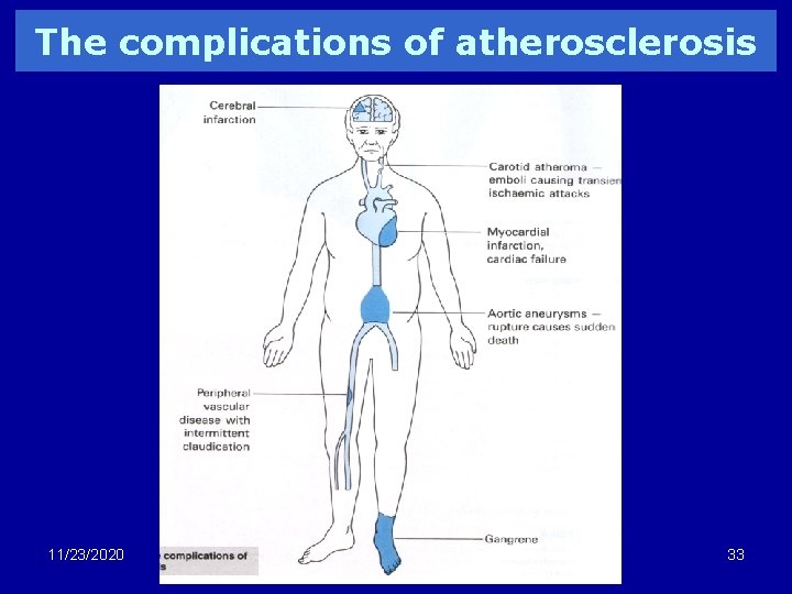 The complications of atherosclerosis 11/23/2020 33 