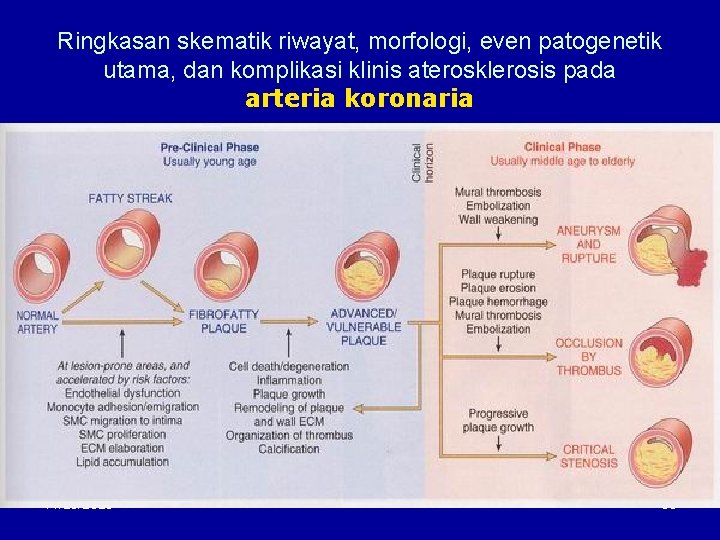Ringkasan skematik riwayat, morfologi, even patogenetik utama, dan komplikasi klinis aterosklerosis pada arteria koronaria