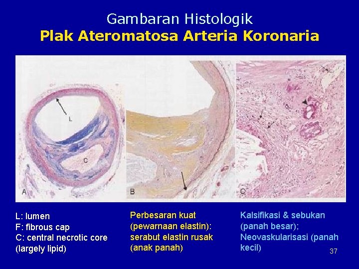 Gambaran Histologik Plak Ateromatosa Arteria Koronaria L: lumen F: fibrous cap C: central necrotic