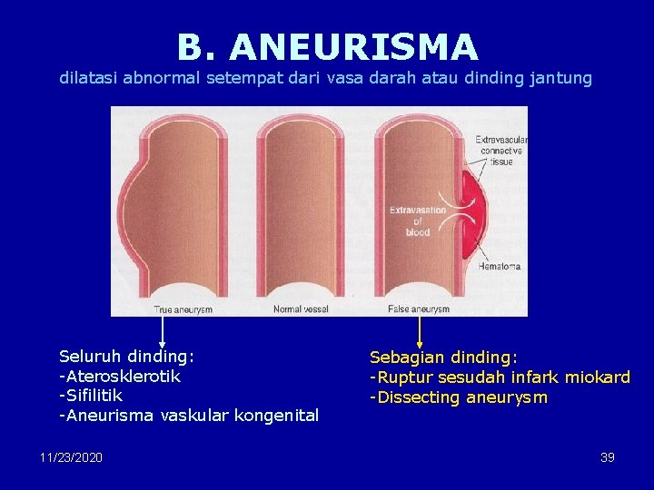 B. ANEURISMA dilatasi abnormal setempat dari vasa darah atau dinding jantung Seluruh dinding: -Aterosklerotik
