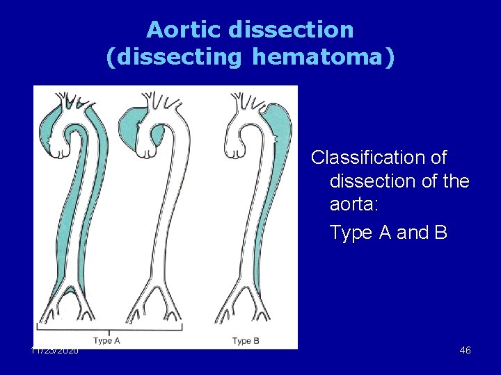 Aortic dissection (dissecting hematoma) Classification of dissection of the aorta: Type A and B