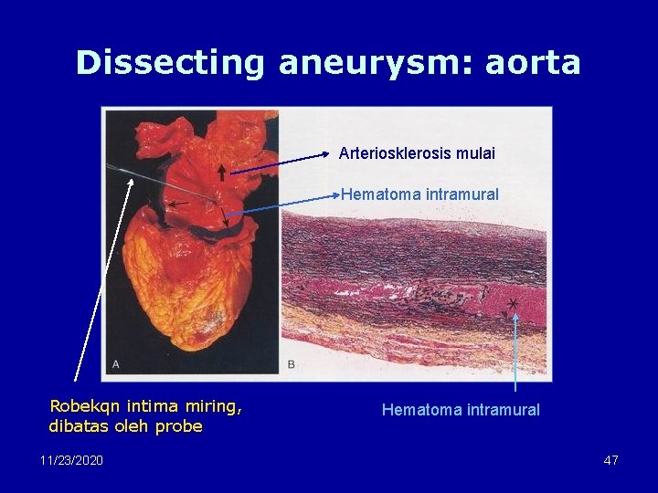 Dissecting aneurysm: aorta Arteriosklerosis mulai Hematoma intramural Robekqn intima miring, dibatas oleh probe 11/23/2020