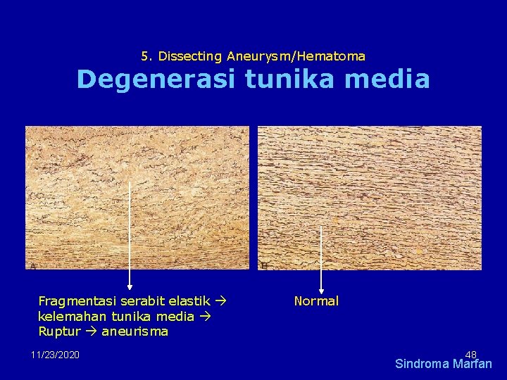 5. Dissecting Aneurysm/Hematoma Degenerasi tunika media Fragmentasi serabit elastik kelemahan tunika media Ruptur aneurisma