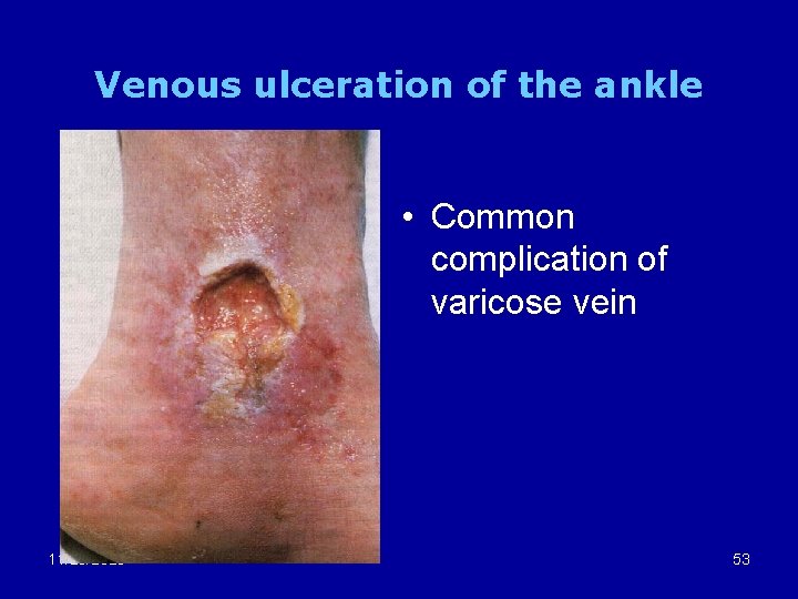 Venous ulceration of the ankle • Common complication of varicose vein 11/23/2020 53 