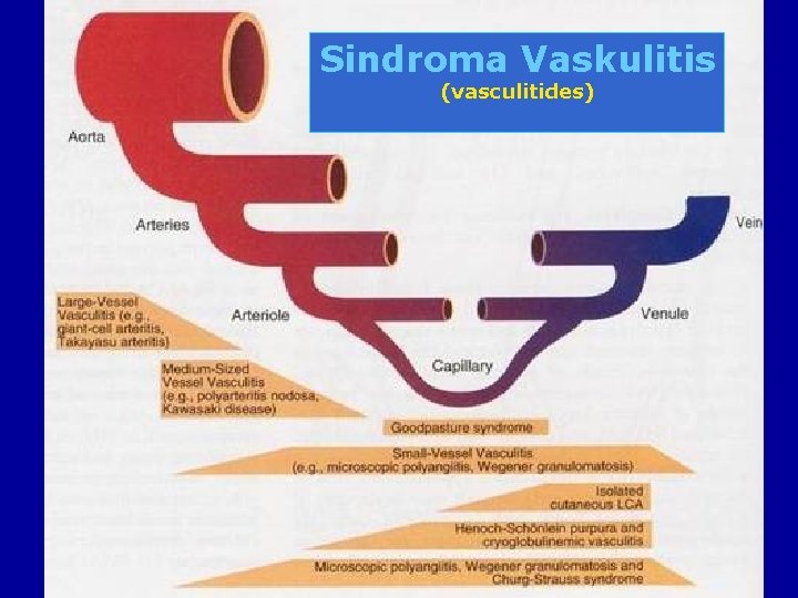 Sindroma Vaskulitis (vasculitides) 11/23/2020 55 