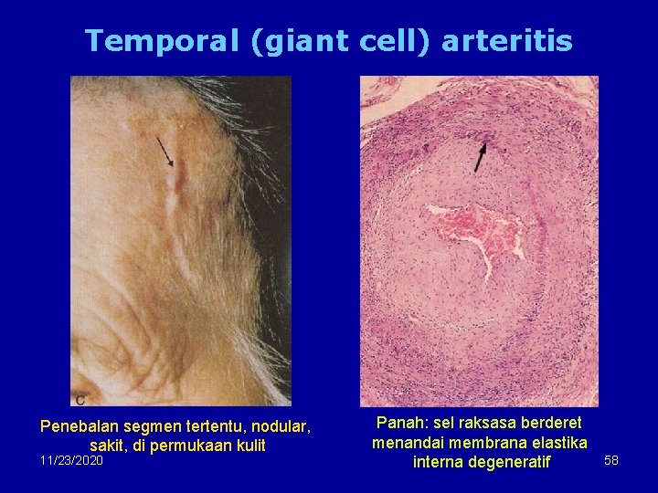 Temporal (giant cell) arteritis Penebalan segmen tertentu, nodular, sakit, di permukaan kulit 11/23/2020 Panah: