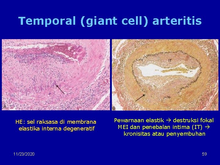Temporal (giant cell) arteritis HE: sel raksasa di membrana elastika interna degeneratif 11/23/2020 Pewarnaan
