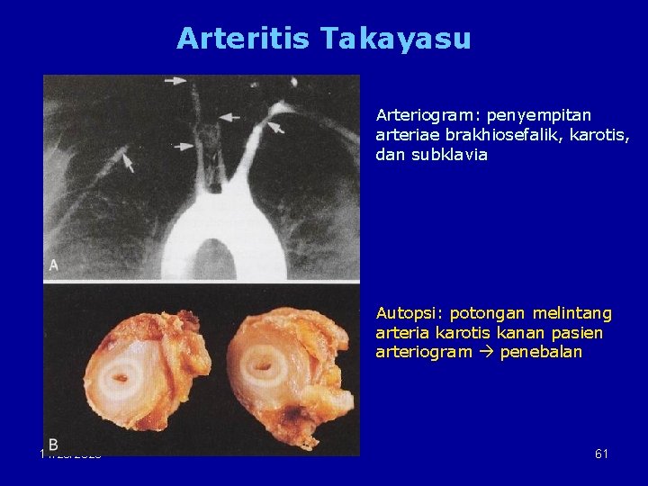 Arteritis Takayasu Arteriogram: penyempitan arteriae brakhiosefalik, karotis, dan subklavia Autopsi: potongan melintang arteria karotis