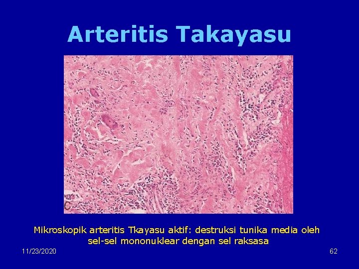 Arteritis Takayasu Mikroskopik arteritis Tkayasu aktif: destruksi tunika media oleh sel-sel mononuklear dengan sel