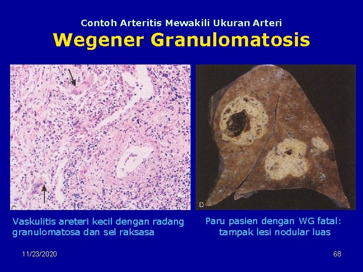 Contoh Arteritis Mewakili Ukuran Arteri Wegener Granulomatosis Vaskulitis areteri kecil dengan radang granulomatosa dan