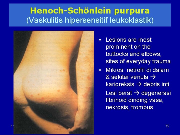 Henoch-Schönlein purpura (Vaskulitis hipersensitif leukoklastik) • Lesions are most prominent on the buttocks and
