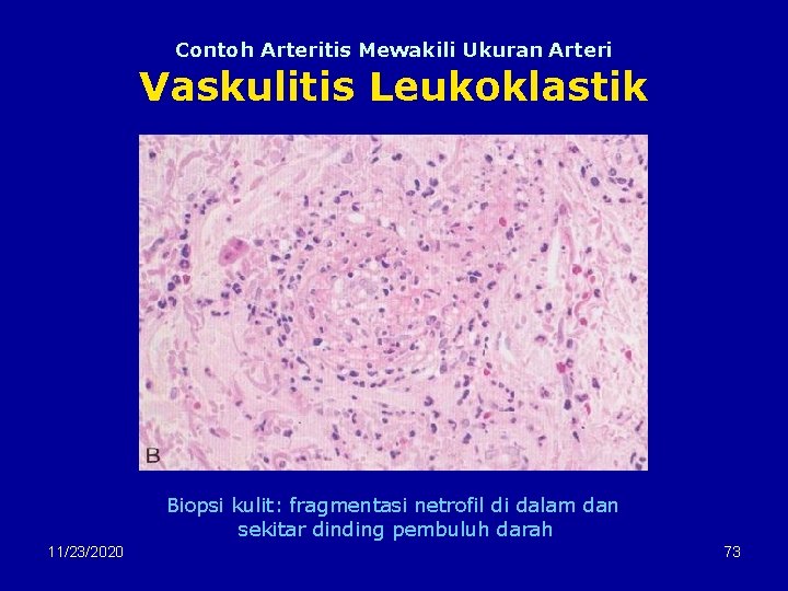 Contoh Arteritis Mewakili Ukuran Arteri Vaskulitis Leukoklastik Biopsi kulit: fragmentasi netrofil di dalam dan