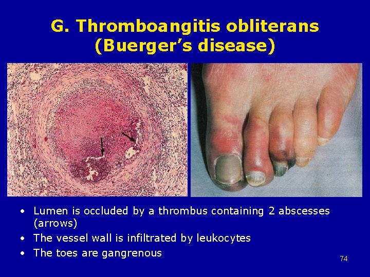 G. Thromboangitis obliterans (Buerger’s disease) • Lumen is occluded by a thrombus containing 2