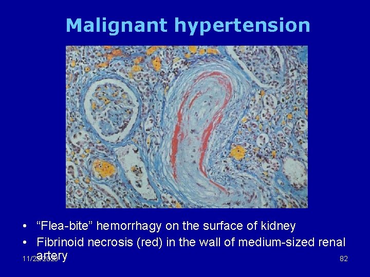 Malignant hypertension • “Flea-bite” hemorrhagy on the surface of kidney • Fibrinoid necrosis (red)