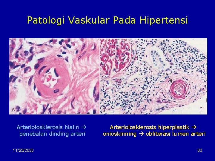 Patologi Vaskular Pada Hipertensi Arteriolosklerosis hialin penebalan dinding arteri 11/23/2020 Arteriolosklerosis hiperplastik onioskinning obliterasi