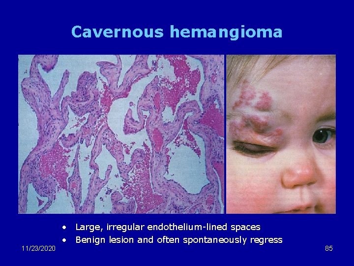 Cavernous hemangioma 11/23/2020 • Large, irregular endothelium-lined spaces • Benign lesion and often spontaneously