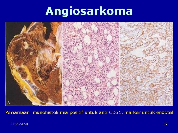 Angiosarkoma Pewarnaan imunohistokimia positif untuk anti CD 31, marker untuk endotel 11/23/2020 87 