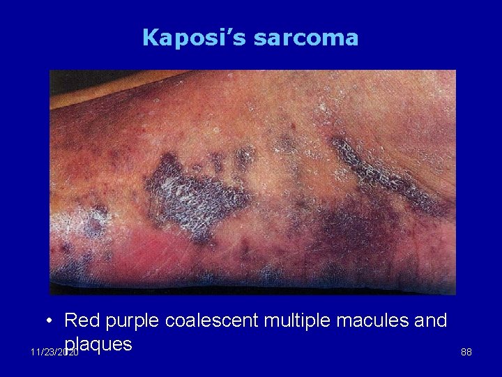 Kaposi’s sarcoma • Red purple coalescent multiple macules and plaques 11/23/2020 88 