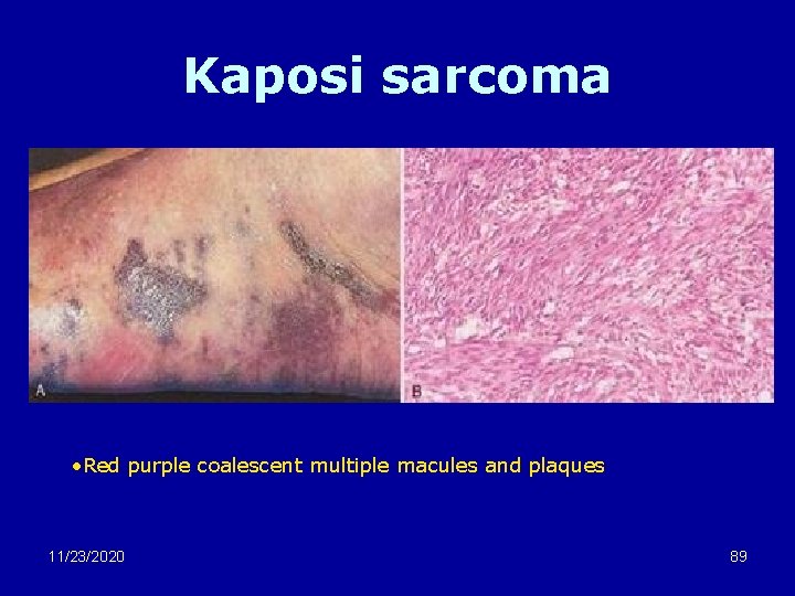 Kaposi sarcoma • Red purple coalescent multiple macules and plaques 11/23/2020 89 