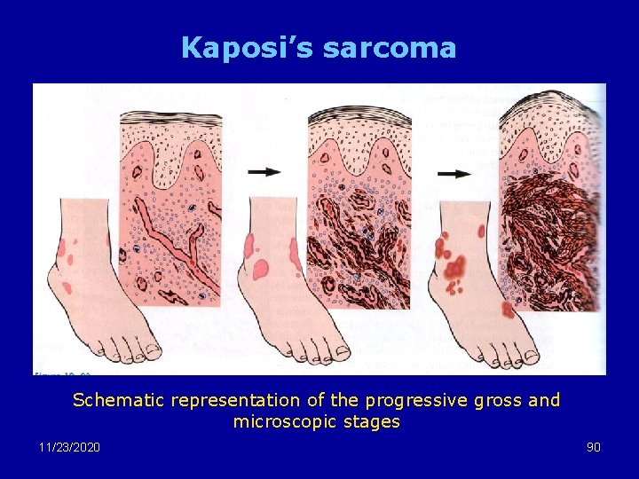 Kaposi’s sarcoma Schematic representation of the progressive gross and microscopic stages 11/23/2020 90 
