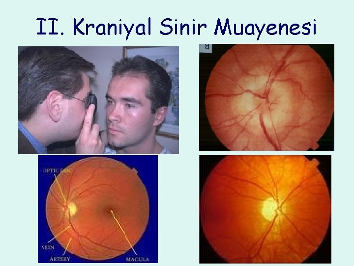 II. Kraniyal Sinir Muayenesi 