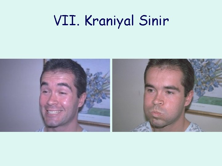 VII. Kraniyal Sinir 