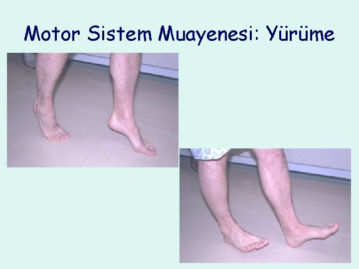 Motor Sistem Muayenesi: Yürüme 