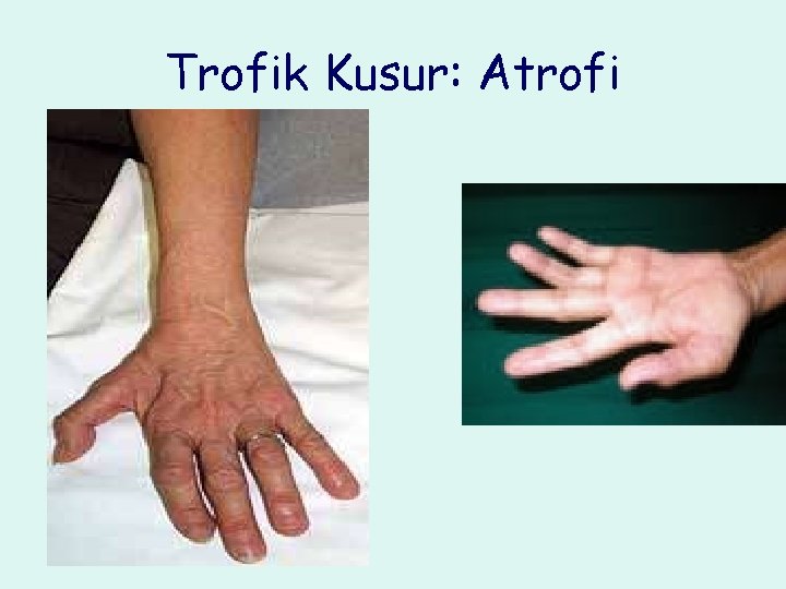 Trofik Kusur: Atrofi 