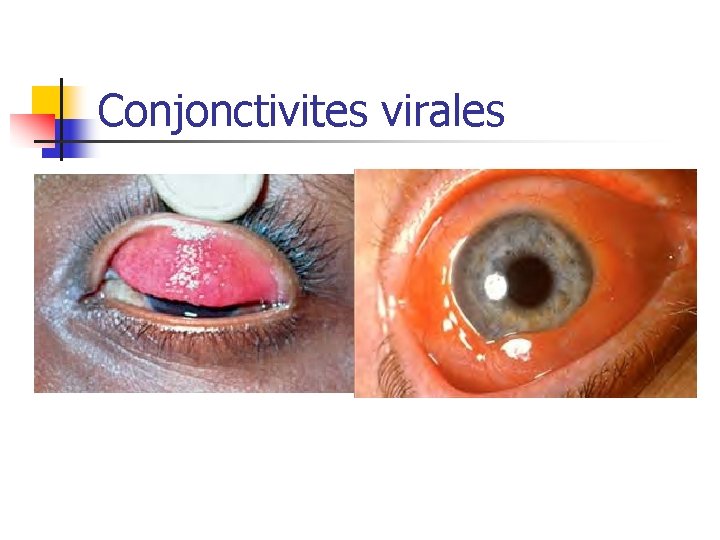 Conjonctivites virales 