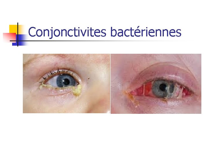 Conjonctivites bactériennes 