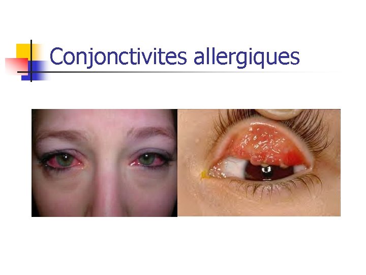 Conjonctivites allergiques 