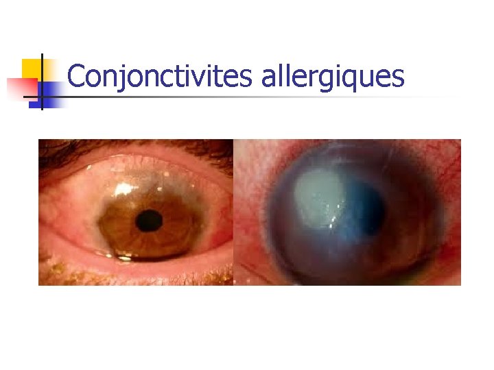 Conjonctivites allergiques 