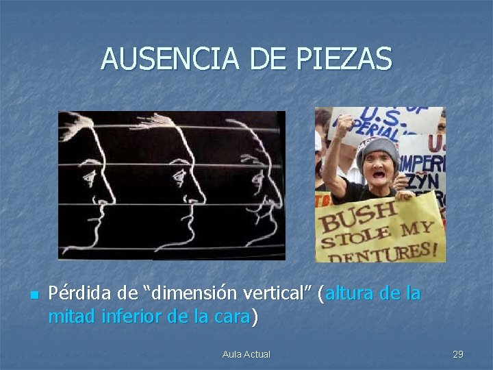 AUSENCIA DE PIEZAS n Pérdida de “dimensión vertical” (altura de la mitad inferior de