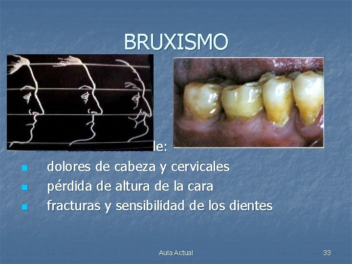 BRUXISMO n n Es causa corriente de: dolores de cabeza y cervicales pérdida de