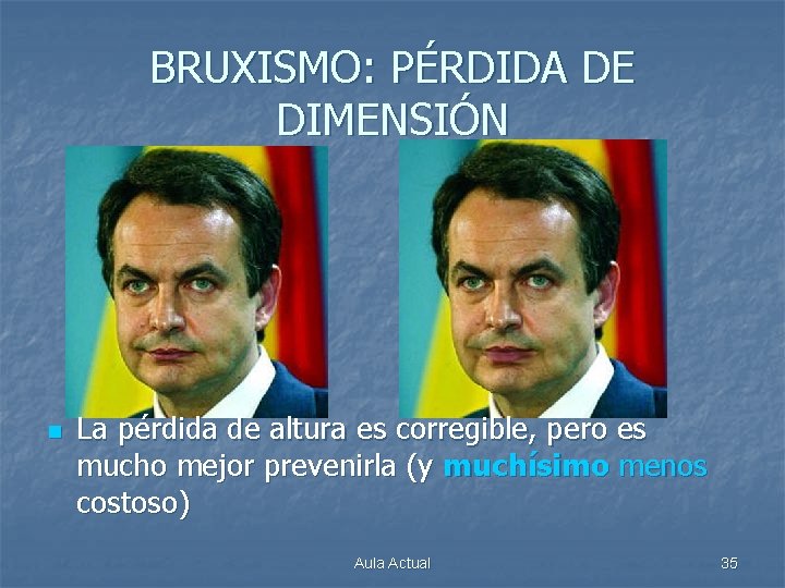BRUXISMO: PÉRDIDA DE DIMENSIÓN n La pérdida de altura es corregible, pero es mucho