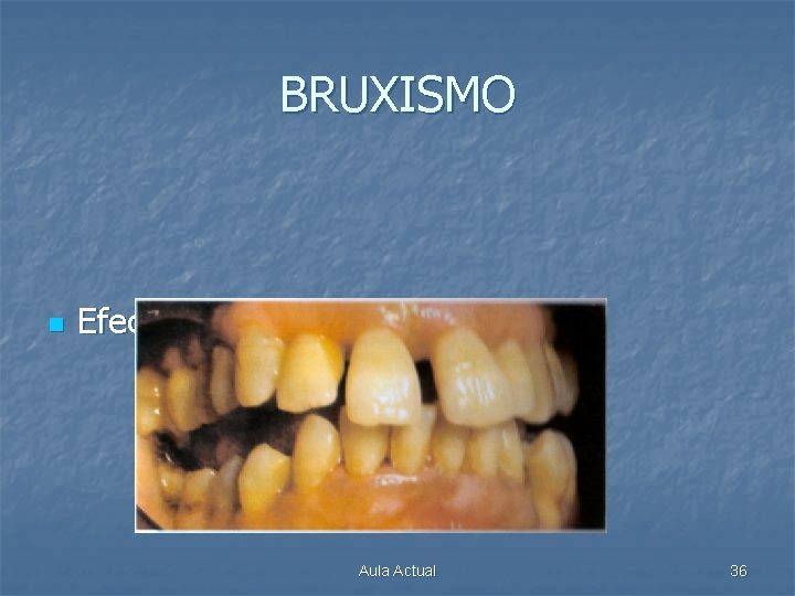 BRUXISMO n Efecto “dientes en abanico” Aula Actual 36 