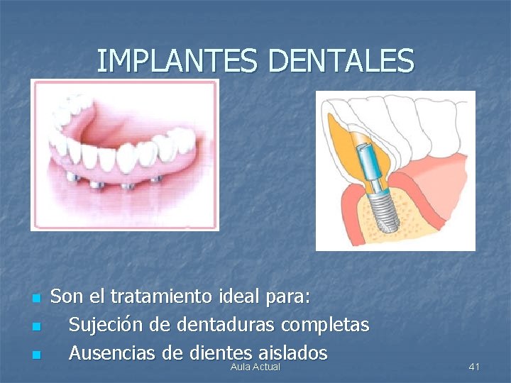 IMPLANTES DENTALES n n n Son el tratamiento ideal para: Sujeción de dentaduras completas