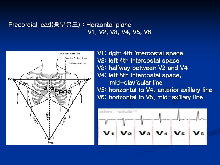 Precordial lead(흉부유도) : Horzontal plane V 1, V 2, V 3, V 4, V