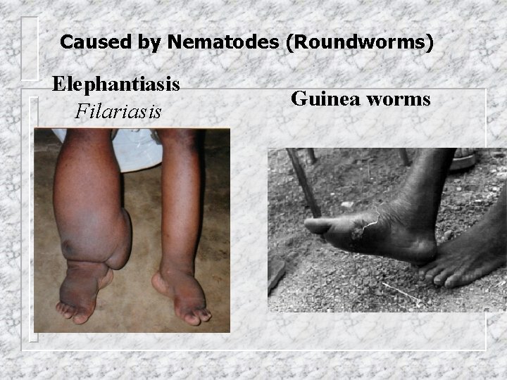 Caused by Nematodes (Roundworms) Elephantiasis Filariasis Guinea worms 