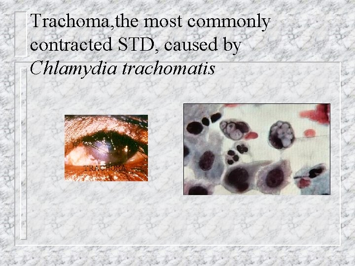 Trachoma, the most commonly contracted STD, caused by Chlamydia trachomatis 