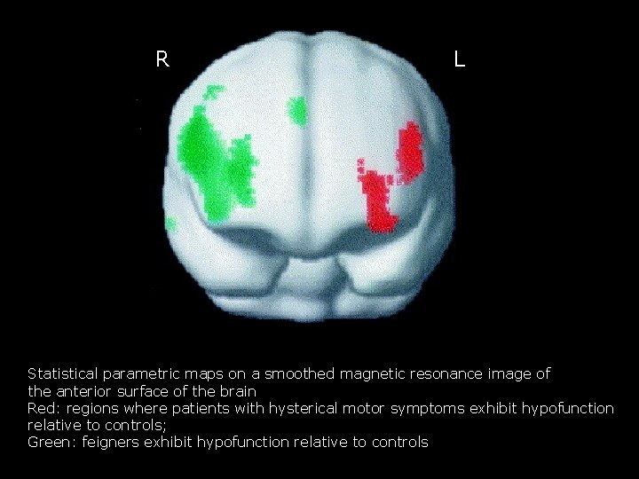 R L Statistical parametric maps on a smoothed magnetic resonance image of the anterior