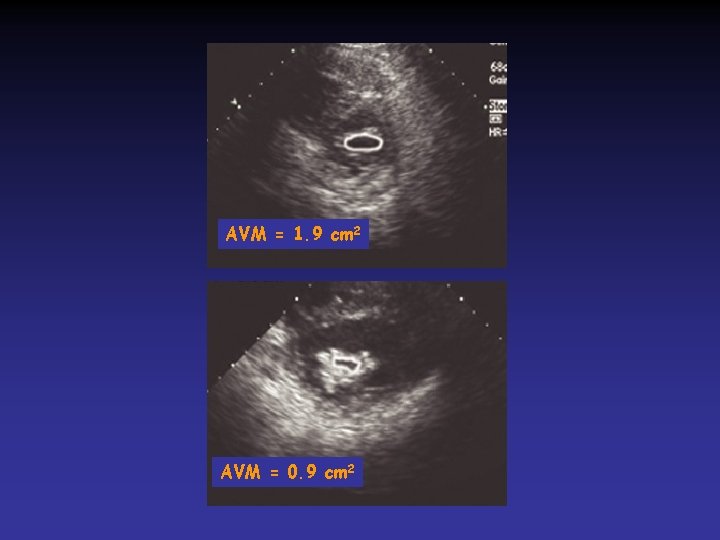 AVM = 1. 9 cm 2 AVM = 0. 9 cm 2 