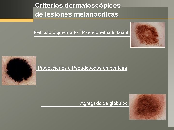 Criterios dermatoscópicos de lesiones melanocíticas Retículo pigmentado / Pseudo retículo facial Proyecciones o Pseudópodos