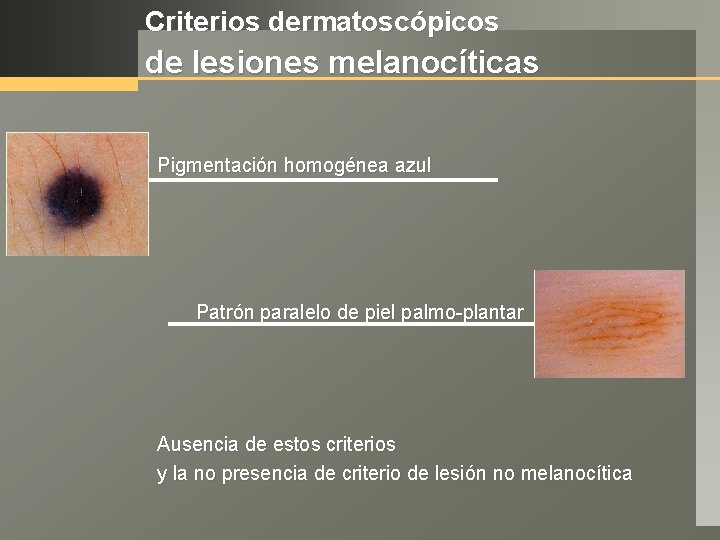 Criterios dermatoscópicos de lesiones melanocíticas Pigmentación homogénea azul Patrón paralelo de piel palmo-plantar Ausencia