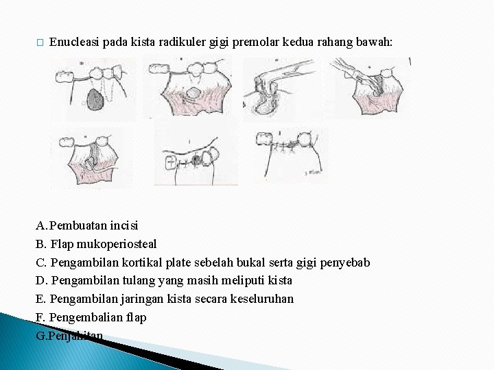 � Enucleasi pada kista radikuler gigi premolar kedua rahang bawah: A. Pembuatan incisi B.