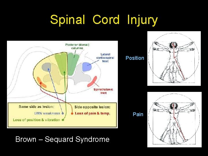 Spinal Cord Injury Position Pain Brown – Sequard Syndrome 